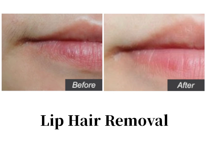 A woman showing before and after results of laser hair removal.